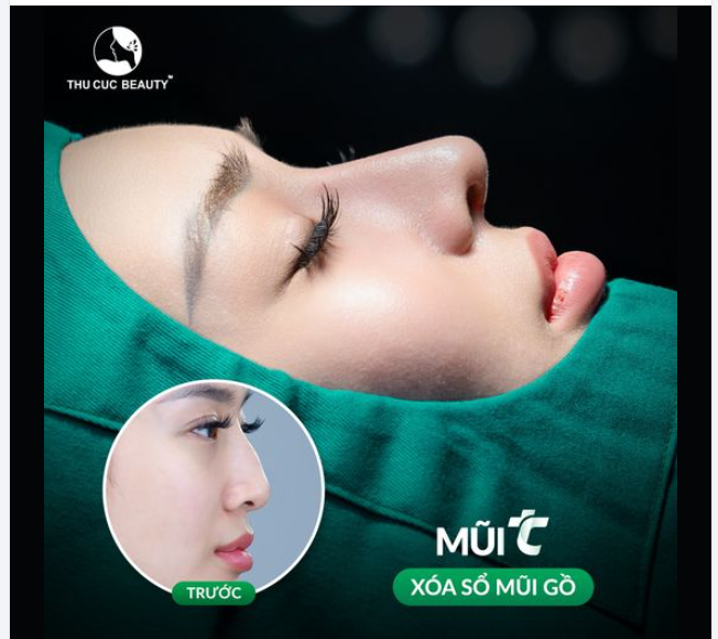 Khách hàng tạm biệt mũi gồ  30P có ngay dáng mũi thời thượng