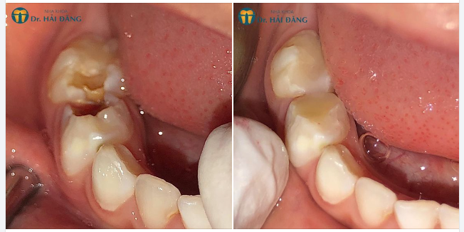 KHẮC PHỤC RĂNG SÂU VỚI DỊCH VỤ HÀN RĂNG THẨM MỸ