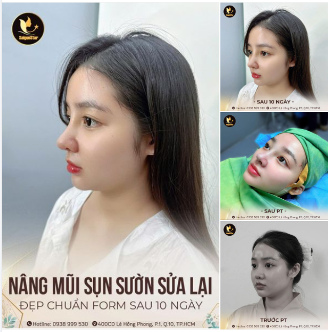 Giải pháp giúp em khách hàng Gen Z khắc phục các biến chứng của lần nâng mũi trước đó.