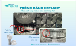 TRỒNG RĂNG IMPLANT, PHỤC HÌNH RĂNG MẤT, ĂN NHAI NHƯ RĂNG THẬT