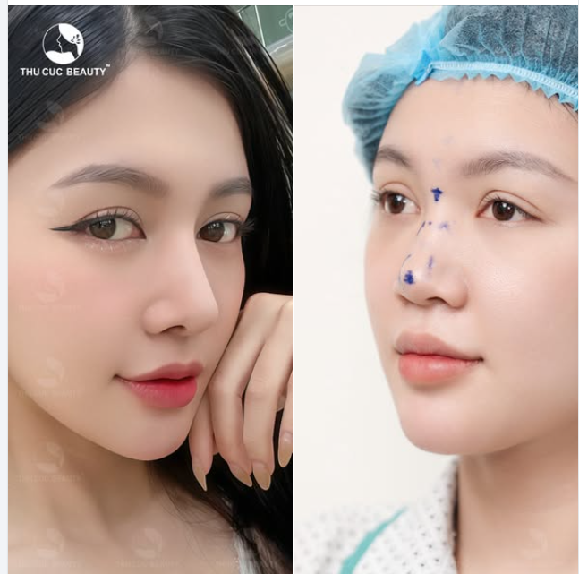 Mũi tẹt hoá S-line cao tây cùng Mũi TC -35% Chỉ 1 thay đổi nhỏ Gương mặt sắc nét, xinh đẹp hơn