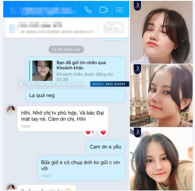 Từng rất tự ti vì dáng mũi thấp ngắn, to bè khiến khuôn mặt thiếu thiện cảm, nay em gái đã tự tin với mọi góc chụp chỉ sau 1 tháng thực hiện nâng mũi bán cấu trúc.