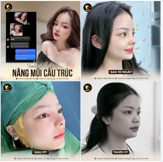 FEEDBACK XINH NHƯ HOTGIRL SAU 8 THÁNG NÂNG MŨI CỦA EM KHÁCH GENZ