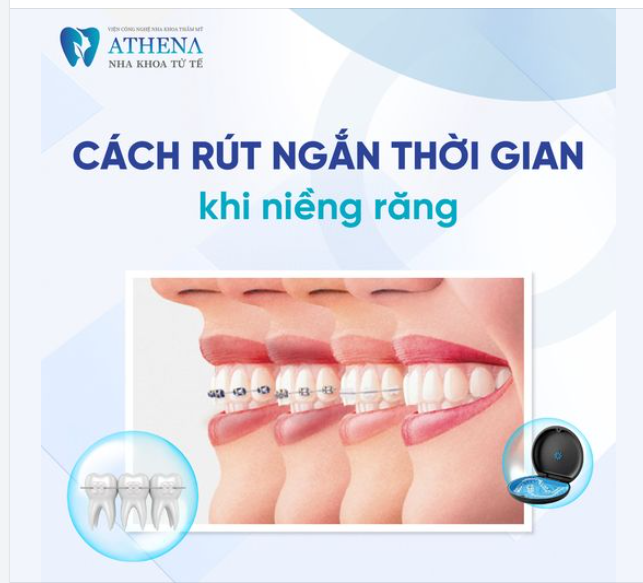Bạn muốn niềng răng nhưng lo lắng thời gian niềng răng quá lâu mà bạn lại không đủ kiên nhẫn?