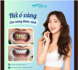 RĂNG Ố VÀNG CÓ LÀM BẠN NGẠI CƯỜI KHÔNG?