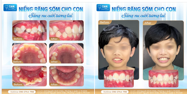 NIỀNG RĂNG SỚM CHO CON - SÁNG NỤ CƯỜI TƯƠNG LAI