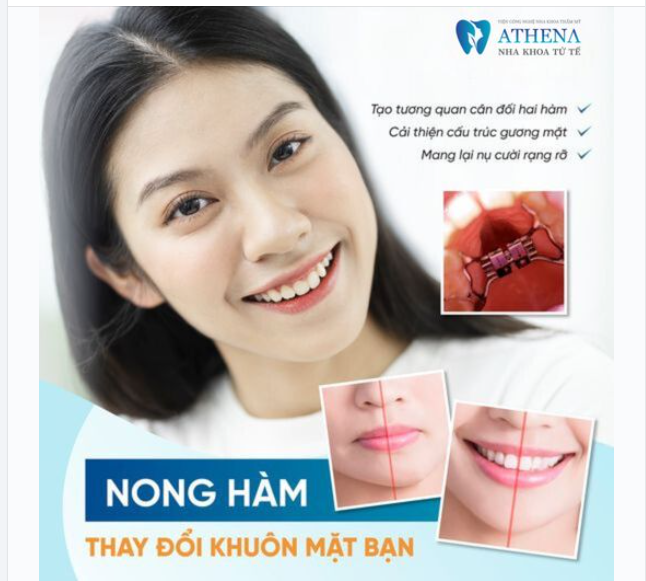 Nong hàm kỹ thuật phổ biến được áp dụng khi niềng răng giúp giải quyết rất nhiều trường hợp như: