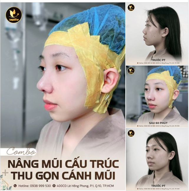 ĐỘNG LỰC NÂNG MŨI CHO CHỊ EM ĐÂY!!!  THON GỌN - CHUẨN FORM SAU 60 PHÚT NÂNG MŨI + CẮT CÁNH MŨI