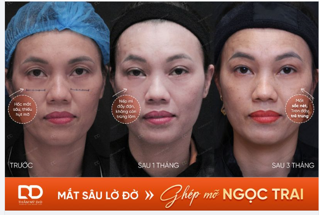 MẮT SÂU LỜ ĐỜ CHỌN GHÉP MỠ NGỌC TRAI