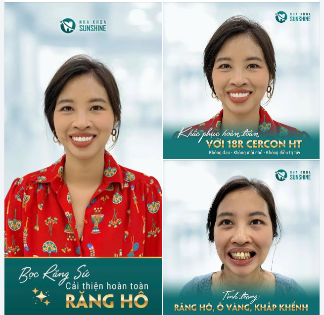 48 GIỜ - HOÀN THIỆN NỤ CƯỜI, TẠM BIỆT RĂNG HÔ, LẤY LẠI TỰ TIN