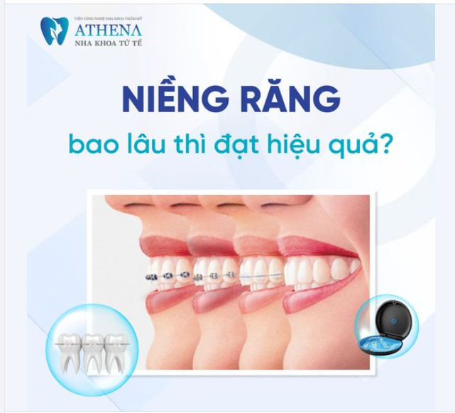 Niềng răng bao lâu thì đạt hiệu quả