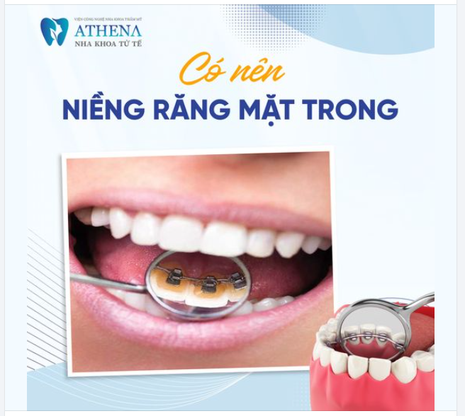 Niềng răng mặt trong, hay còn gọi là niềng răng mặt lưỡi, ngày càng được nhiều người biết đến nhờ ưu điểm giấu mắc cài ở phía trong, giúp người niềng giữ được tính thẩm mỹ tối đa.