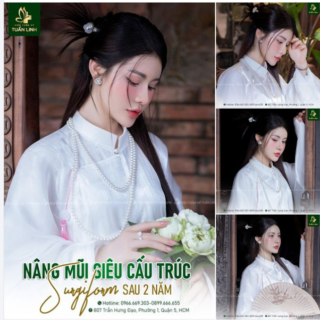 Mũi siêu cấu trúc Surgiform sau 2 năm đẹp xuất sắc!!