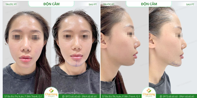 Trước khi thực hiện phẫu thuật độn cằm, nàng khách hàng có dáng cằm bị lệch và thiếu độ nhô, khiến khuôn mặt trông mất cân đối.