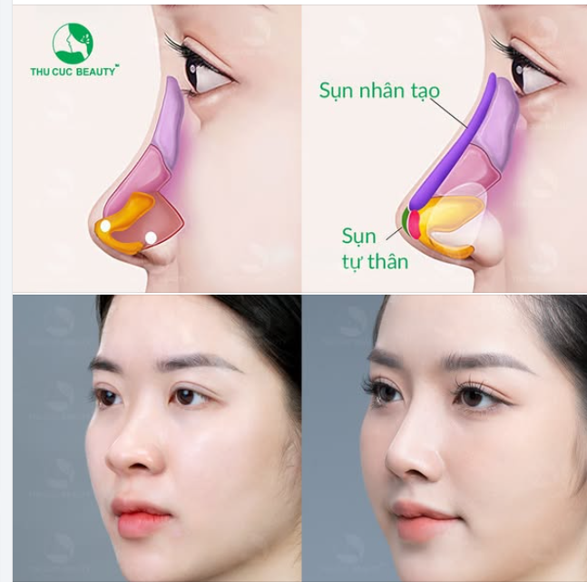 Loại bỏ mũi thấp sau 30P cùng Mũi TC -35%  Khách hàng tự tin hơn với diện mạo mới