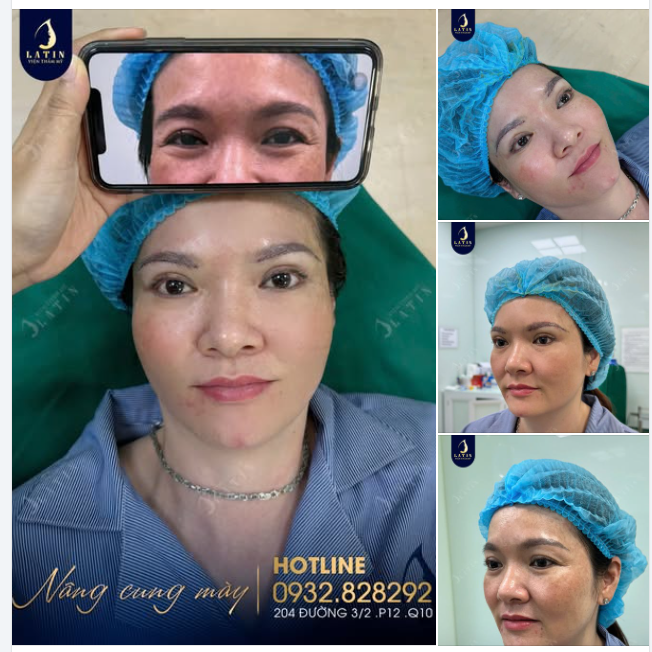 KẾT QUẢ NÂNG CUNG MÀY ĐA TẦNG CHO CHỊ GÁI QUÊ HẬU GIANG