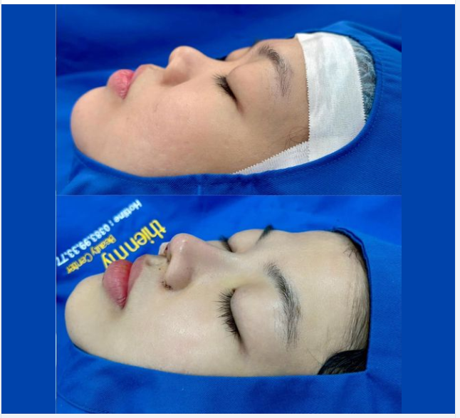 Khám Phá Vẻ Đẹp Tự Nhiên Với Nâng Mũi Cấu Trúc!