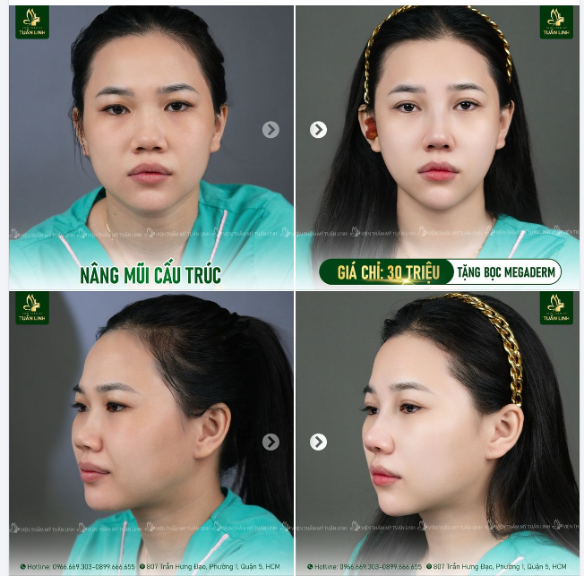 Mũi cấu trúc giá ƯU ĐÃI Chỉ 30TR INBOX tư vấn và đặt lịch phẫu thuật sớm nhất!!
