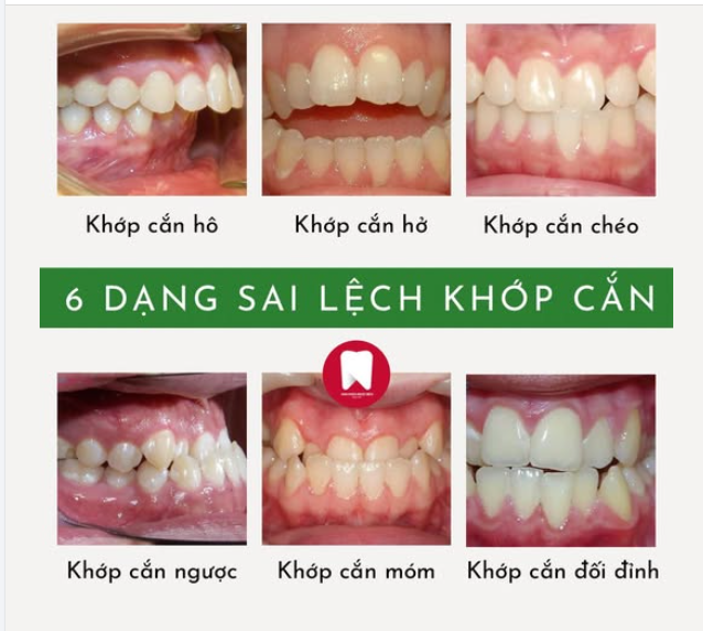 6 DẠNG KHỚP CẮN LỆCH PHỔ BIẾN