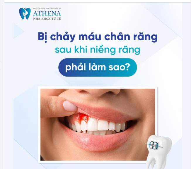 Bị Chảy máu chân răng sau khi niềng phải làm sao?
