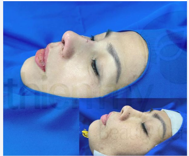 Cảm ơn chị khách từ nước ngoài về đã tin tưởng và lựa chọn Thiện Mỹ để thực hiện dịch vụ Nâng mũi