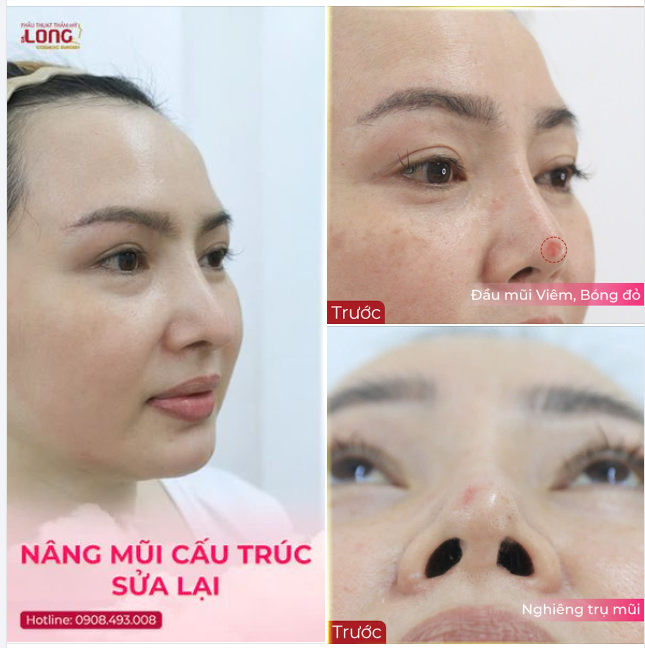 KẾT QUẢ DÁNG MŨI CỦA CHỊ PHƯƠNG SAU KHI ĐƯỢC BÁC SĨ LONG GIẢI CỨU