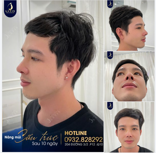 Nâng mũi để "kịp" đón Tết mà mới 10 ngày mũi đã đẹp quá rồi
