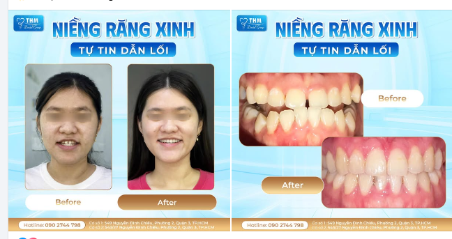 NIỀNG RĂNG XINH - TỰ TIN DẪN LỐI