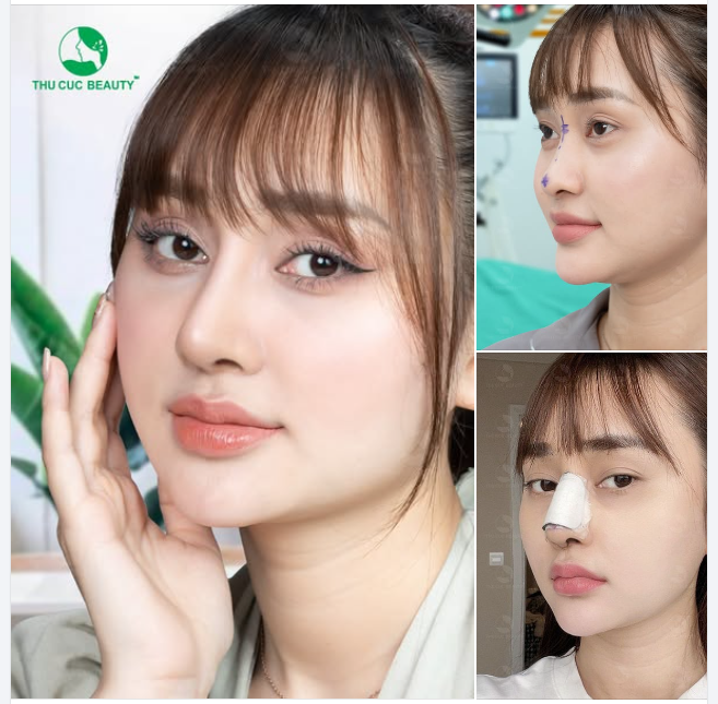 ​​​​​​​Nâng mũi TC Mũi cao, thon gọn, hài hòa khuôn mặt