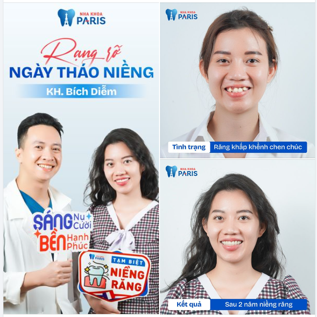 RẠNG RỠ NGÀY THÁO NIỀNG CÙNG NHA KHOA PARIS