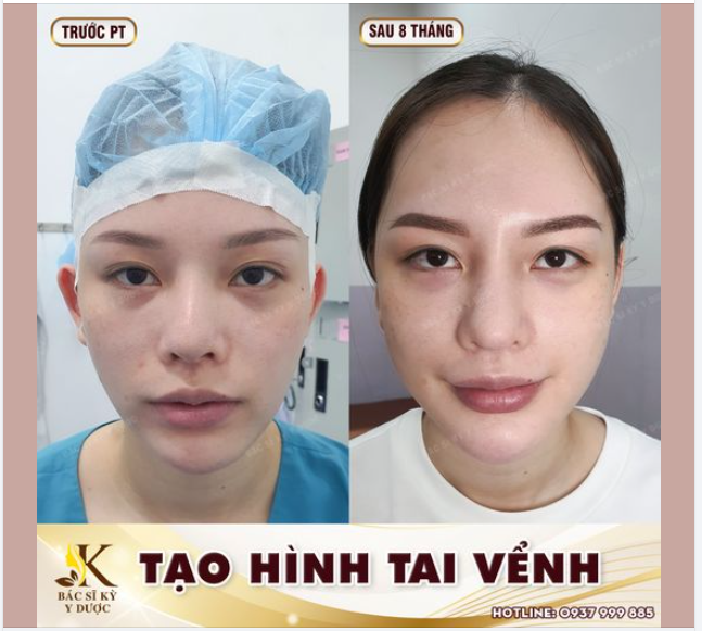 Tạo Hình Tai Vểnh tại Bác sĩ Kỳ Y Dược có được vĩnh viễn không???