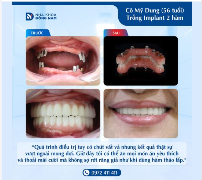 GẮN RĂNG IMPLANT HOÀN TẤT - NGÀY KHÁCH HÀNG NÀO CŨNG MONG ĐỢI