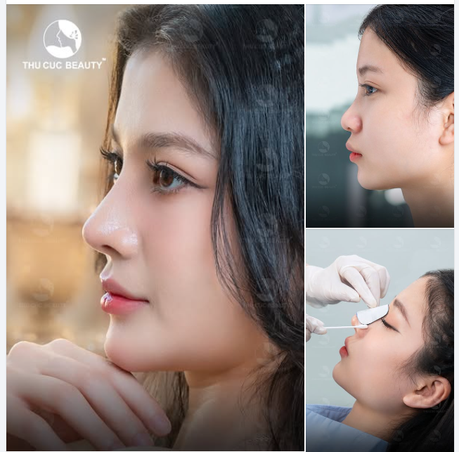 Góc nghiêng hoàn hảo sau nâng mũi