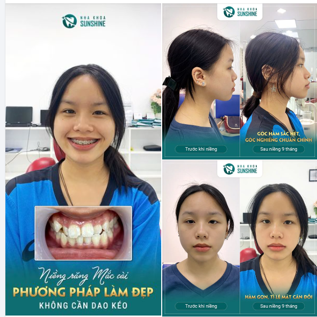 NIỀNG RĂNG MẮC CÀI - PHƯƠNG PHÁP LÀM ĐẸP KHÔNG CẦN DAO KÉO