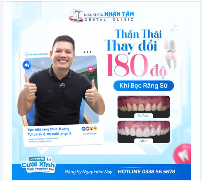 Thần thái thay đổi 180° sau khi BỌC RĂNG SỨ