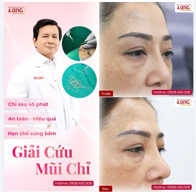 GIẢI CỨU “MŨI CHỈ”  Đừng để sắc đẹp trở thành rủi ro đáng tiếc!