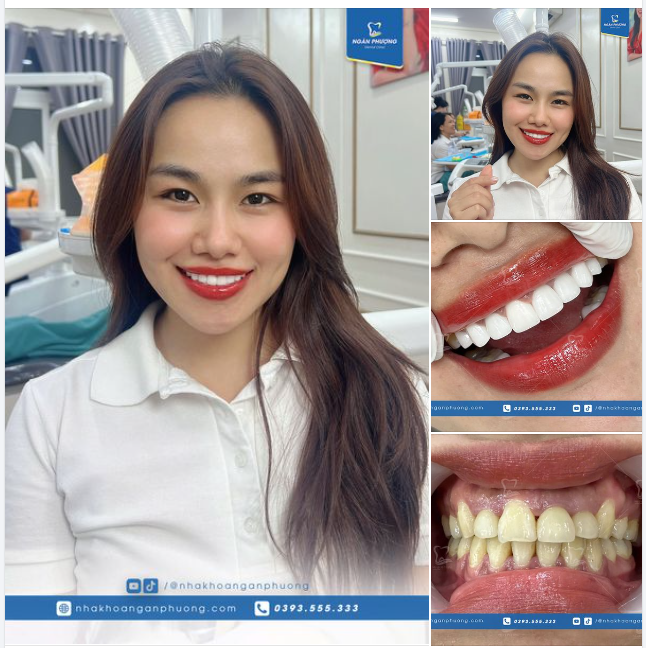 Chị đẹp Sài Gòn rạng rỡ với răng sứ dáng Natural