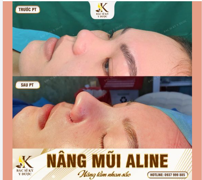 CHỌN NÂNG MŨI ALINE - CÓ NGAY DÁNG MŨI ĐẸP