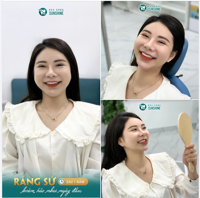 TÁI KHÁM RĂNG SỨ SAU 1 NĂM – NỤ CƯỜI HOÀN HẢO NHƯ NGÀY ĐẦU