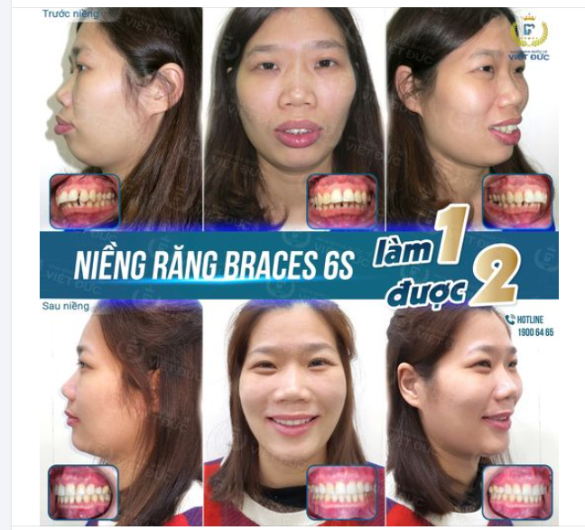 CHƯA BAO GIỜ LÀ QÚA MUỘN ĐỂ THAY ĐỔI  ️MỪNG NGÀY THÁO NIỀNG: KHÁCH HÀNG TRẦN THỊ THÚY LAN️