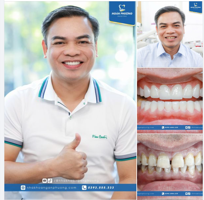Hành trình tạm biệt răng thưa, ố vàng cùng anh Đỗ Hiếu