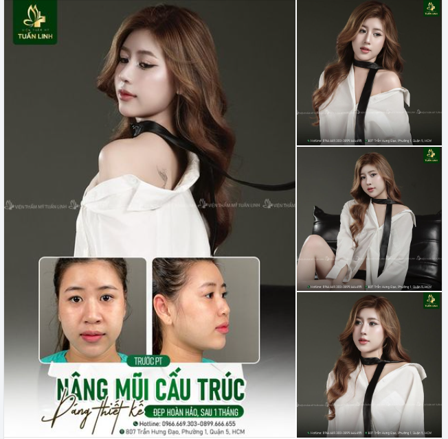 Nâng mũi cấu trúc dáng thiết kế - Đẹp hoàn hảo sau 1 tháng!!