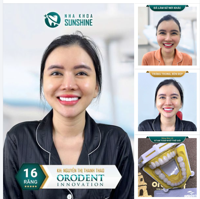 TÁI TẠO NỤ CƯỜI - KHẮC PHỤC HOÀN TOÀN SAU HAI LẦN CHƯA ƯNG Ý