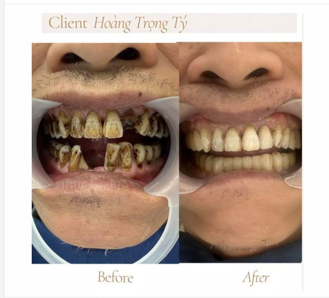 Sâu kẽ, ố vàng, mòn mẻ, tất cả đều được khắc phục chỉ sau 3 ngày