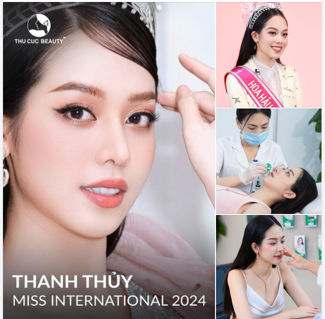 30P thực hiện tại phòng mổ vô khuẩn chuẩn Quốc tế  5 ngày vào form. Không bóng đỏ. Không lộ sụn  Mũi cao thon gọn. Hài hòa. Tự nhiên