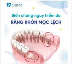 Răng khôn mọc lệch không chỉ gây đau nhức mà còn có thể gây ra những biến chứng nghiêm trọng nếu không được xử lý kịp thời.