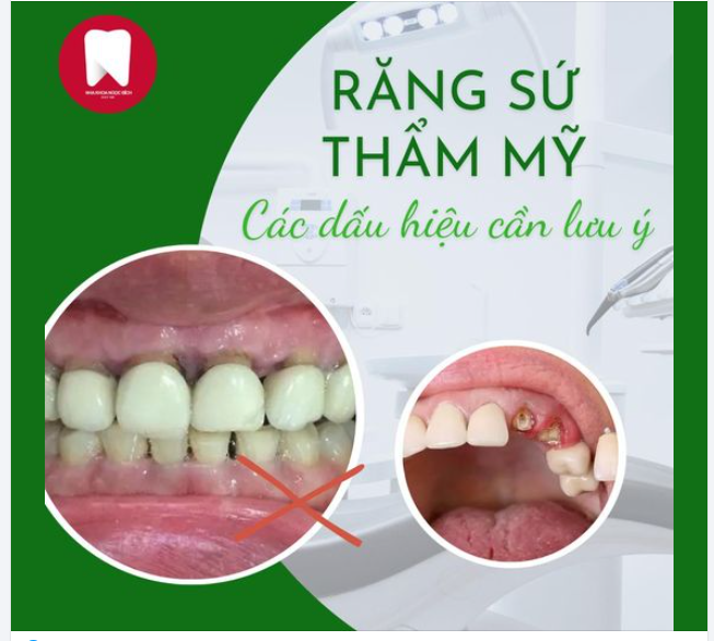 CÁC DẤU HIỆU CẨN LƯU Ý KHI LÀM RĂNG SỨ THẨM MỸ