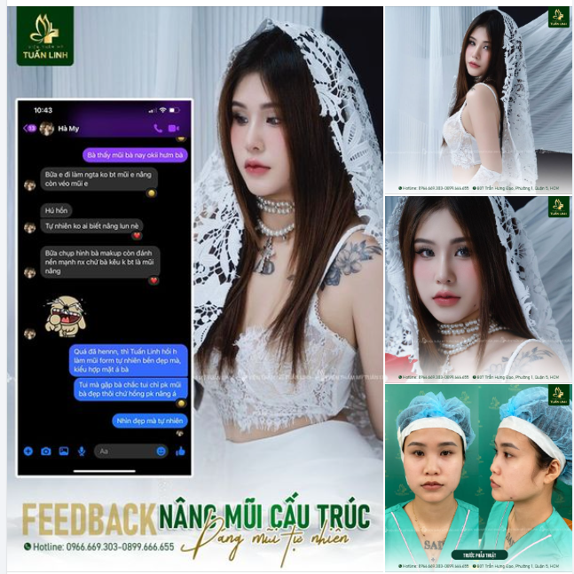 Feedback nâng mũi sang, xịn, mịn của khách nhà Tuấn Linh!!