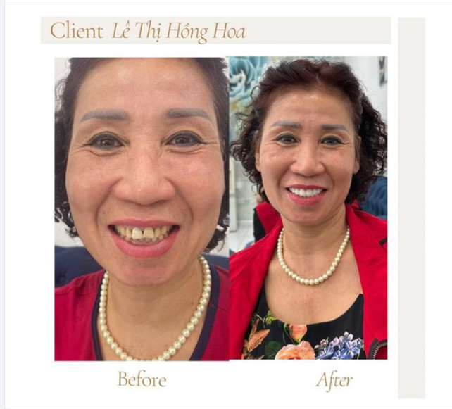 Làm răng tức thì – Khôi phục nụ cười sau 72h cho cô Lê Thị Hồng Hoa (Berlin- Đức)