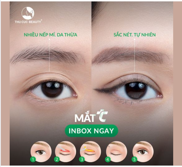 Dành tặng 10 suất cắt mí -35% cho chị em nào đang bị sụp mí, da thừa, nhiều mỡ